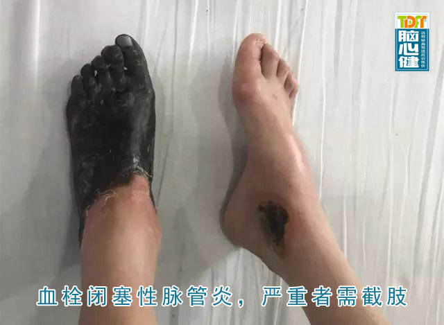 血栓闭塞性脉管炎,好发于吸烟男性,严重者需截肢
